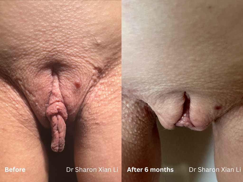 Labiaplasty