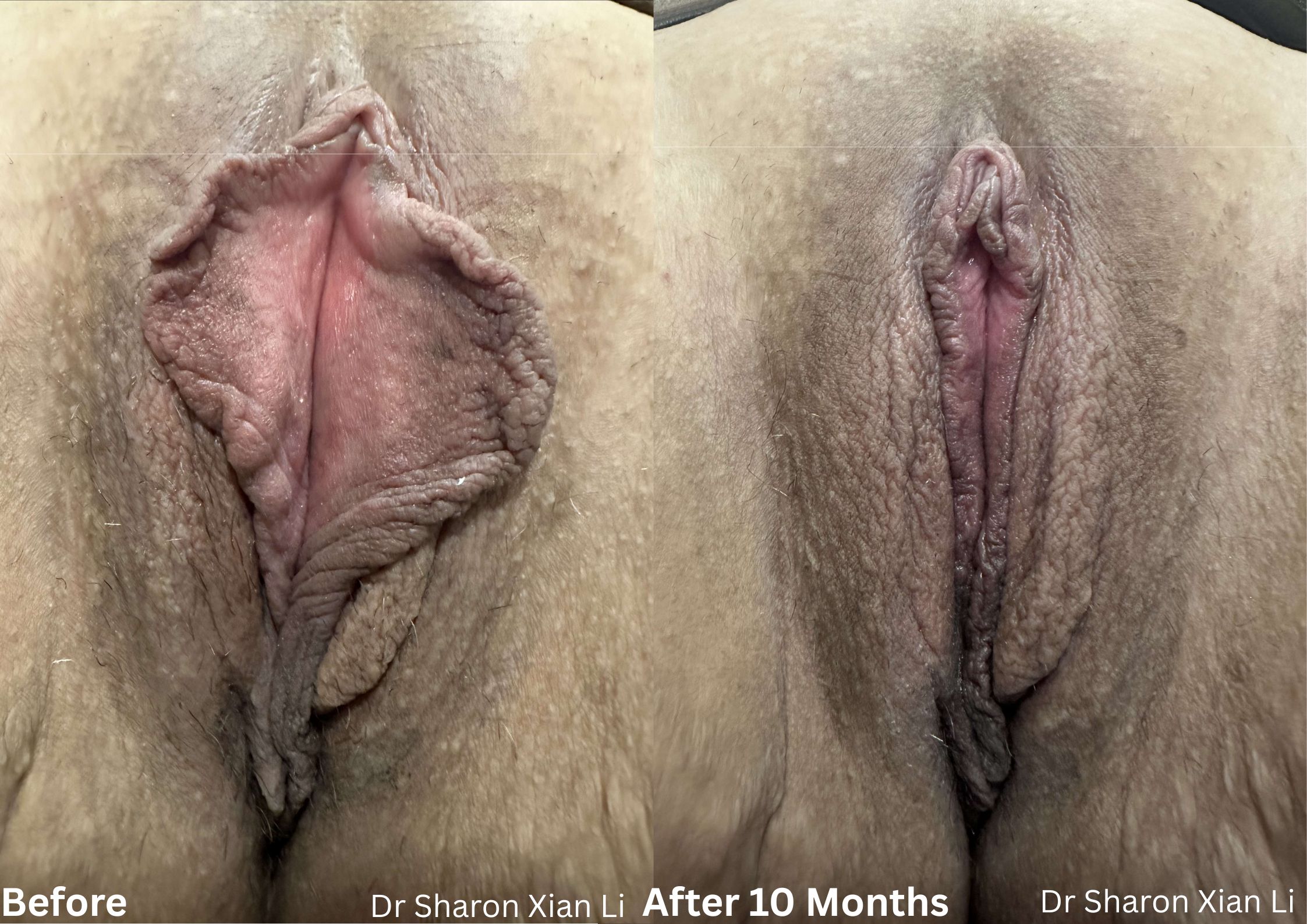 Labiaplasty